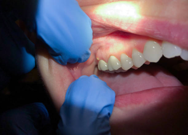 Best Emergency Dentist for Lost Fillings or Crowns in Lanai City, HI